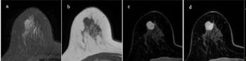 Breast MRI Study Examines Common Factors with False Negatives and False Positives