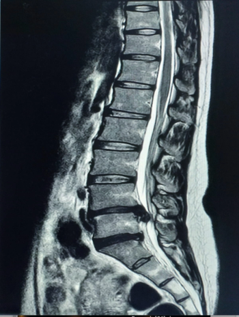 FDA Clears AI Software for Lumbar Spine MRI Analysis