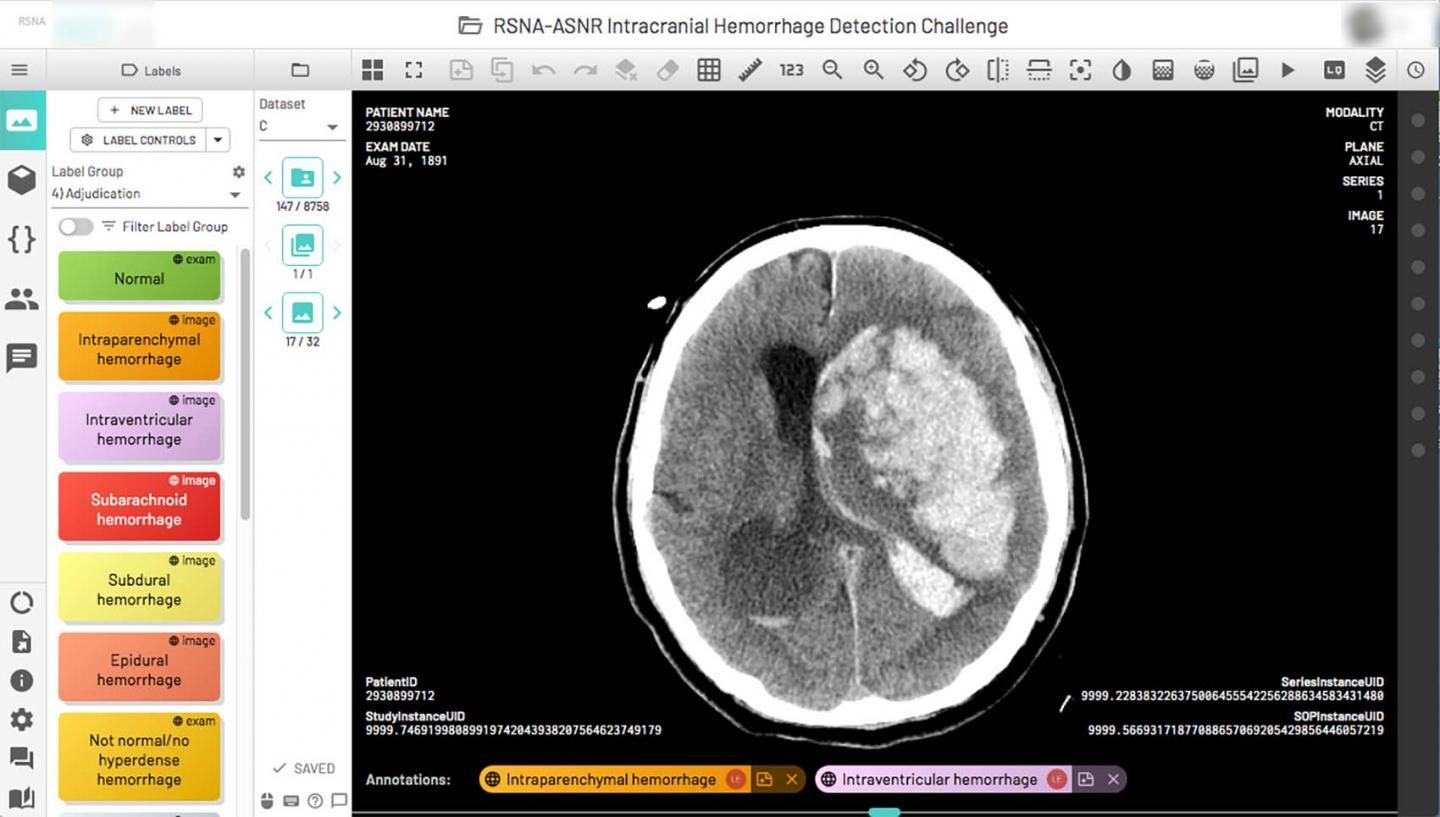 RSNA Challenge Opens Door for Brain Hemorrhage Machine Learning