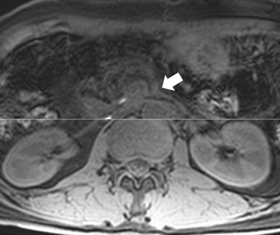 Can Diffusion-Weighted MRI Have an Impact in Detecting Recurrent Pancreatic Cancer?