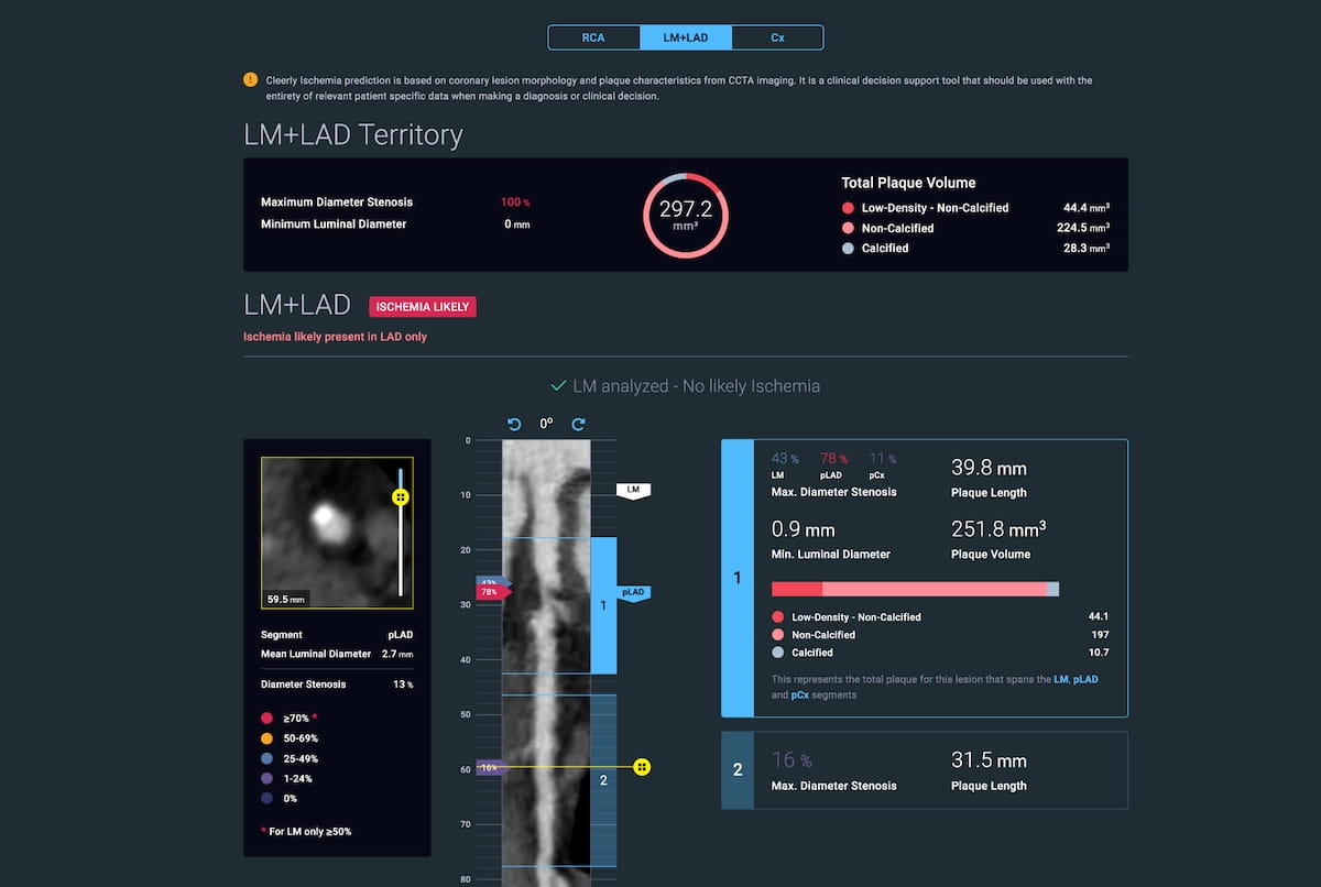 AMA Issues New CPT Code for AI Estimates of CCTA-Based Fractional Flow Reserve 