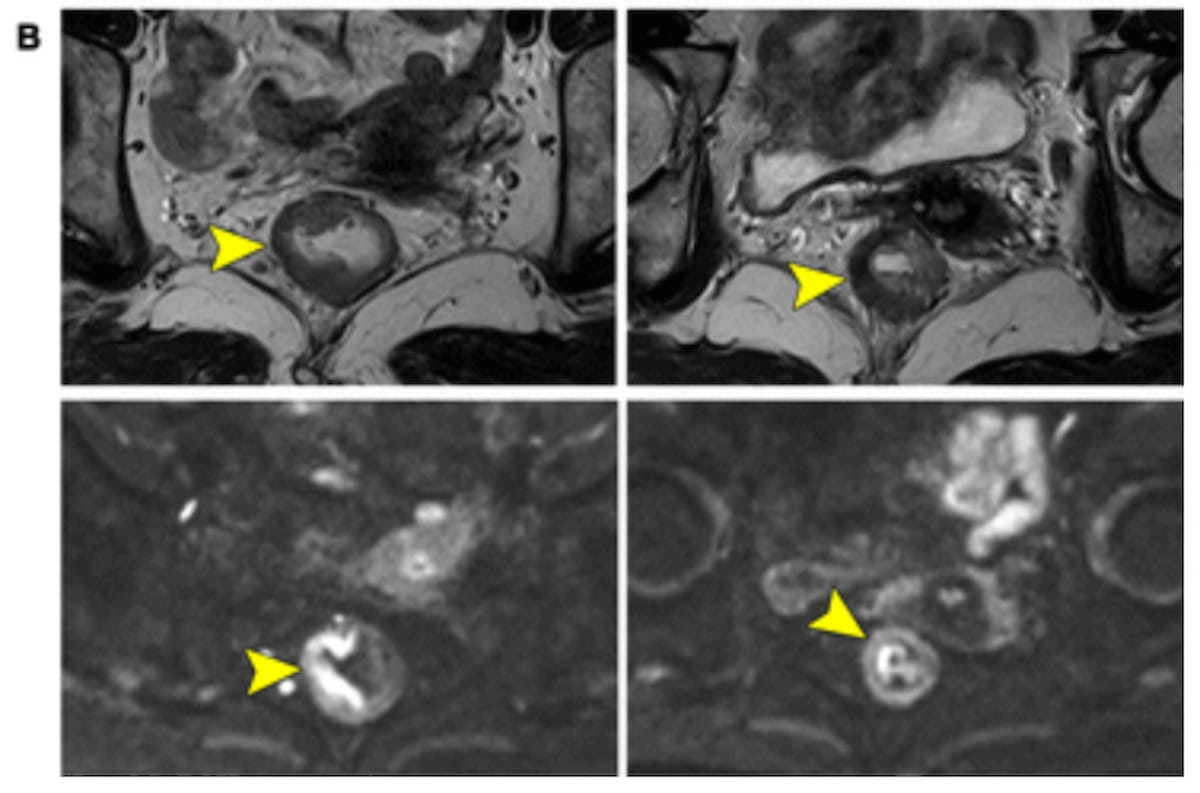 Diffusion-Weighted MRI and Neoadjuvant Chemotherapy for Rectal