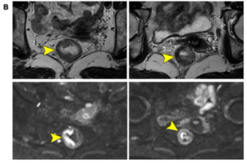 Diffusion-Weighted MRI and Neoadjuvant Chemotherapy for Rectal Cancer: What New Research Reveals