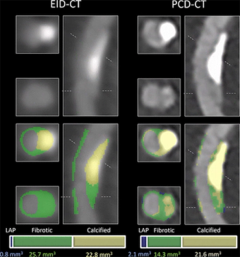 New Analysis Forecasts Substantial Cost Savings with the Use of Photon Counting CT for CCTA
