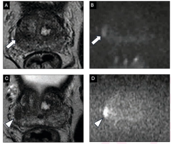 Going Beyond PI-RADS: A Closer Look at Emerging Prostate MRI Scoring Systems