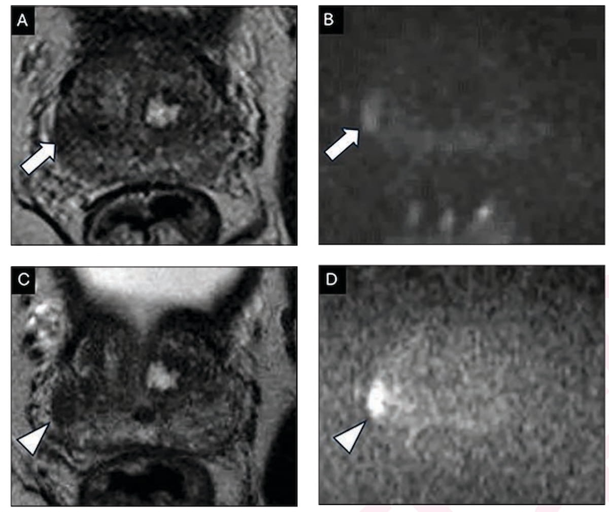 Going Beyond PI-RADS: A Closer Look at Emerging Prostate MRI Scoring ...