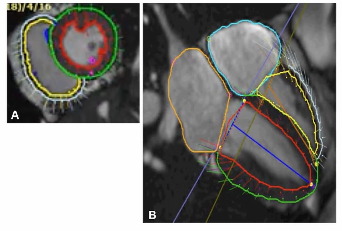 Is MRI Assessment of Right Ventricular Global Longitudinal Strain Prognostic for Heart Failure?