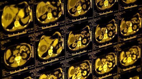 16 New Guidelines for Lung Cancer Screening