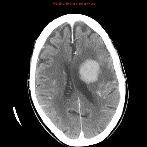 Meningioma | Diagnostic Imaging