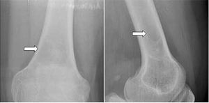 Unicameral Bone Cyst