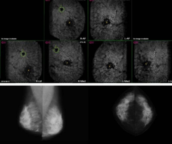 Can Multimodal AI Improve Cancer Detection in Dense Breasts?
