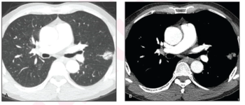 CT Study Links Better Five-Year Prognosis with Minor Ground Glass Opacity Component in NSCLC Lung Nodules