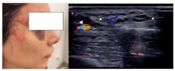 Seven Takeaways for Ultrasound Imaging of Patients Who Had Cosmetic Fillers
