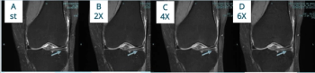 Study Examines Impact of Deep Learning on Fast MRI Protocols for Knee Pain