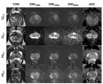 5T Prostate MRI Study Reveals Enhanced Image Quality and Detection
