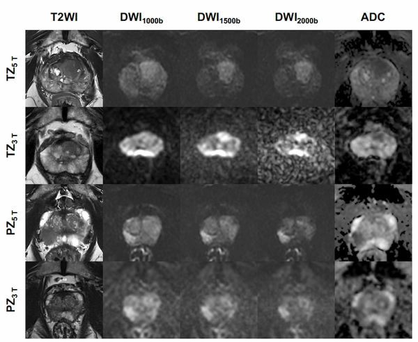 5T Prostate MRI Study Reveals Enhanced Image Quality and Detection
