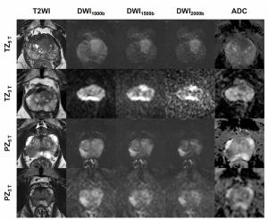 5T Prostate MRI Study Reveals Enhanced Image Quality and Detection