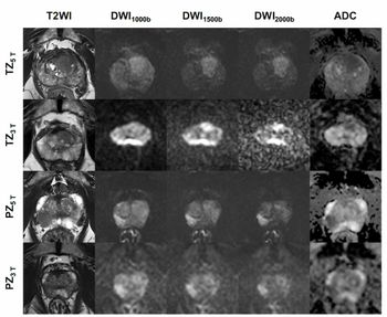 5T Prostate MRI Study Reveals Enhanced Image Quality and Detection