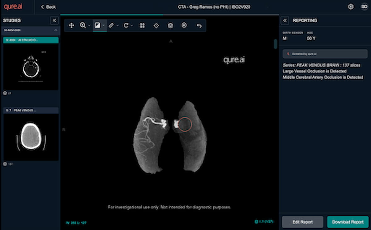 FDA Clears AI Software for Large Vessel Occlusion Detection on CT Angiography Scans