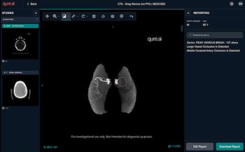 FDA Clears AI Software for Large Vessel Occlusion Detection on CT Angiography Scans