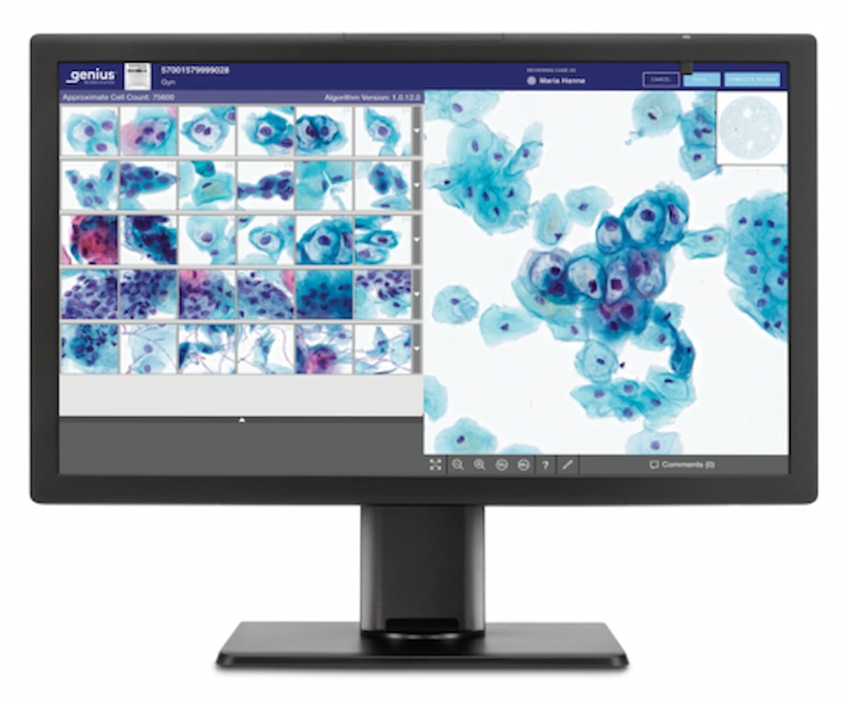 Cytovision FDA Clears AI-Powered Digital Cytology Platform for Cervical Cancer