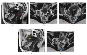 Can Abbreviated MRI Have an Impact in Rectal Cancer Staging?