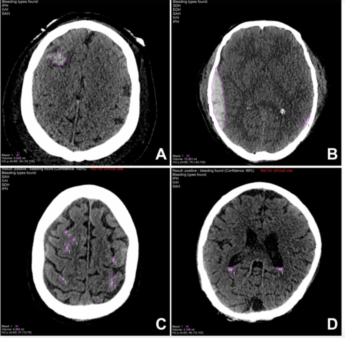Can Deep Learning Enhance Non-Contrast CT Detection of Intracranial Hemorrhages?