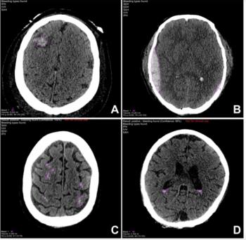 Can Deep Learning Enhance Non-Contrast CT Detection of Intracranial Hemorrhages?