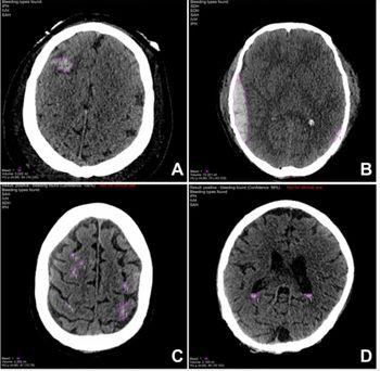Can Deep Learning Enhance Non-Contrast CT Detection of Intracranial Hemorrhages?