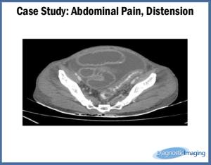 Abdominal Pain, Distension