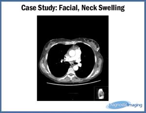 Facial, Neck Swelling