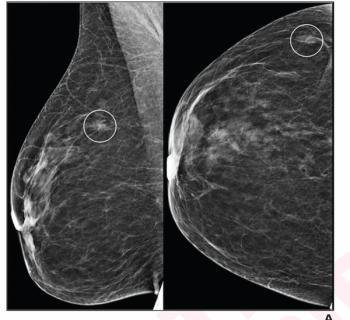 Large Mammography Study Shows Mixed Results with AI in Breast Cancer Screening