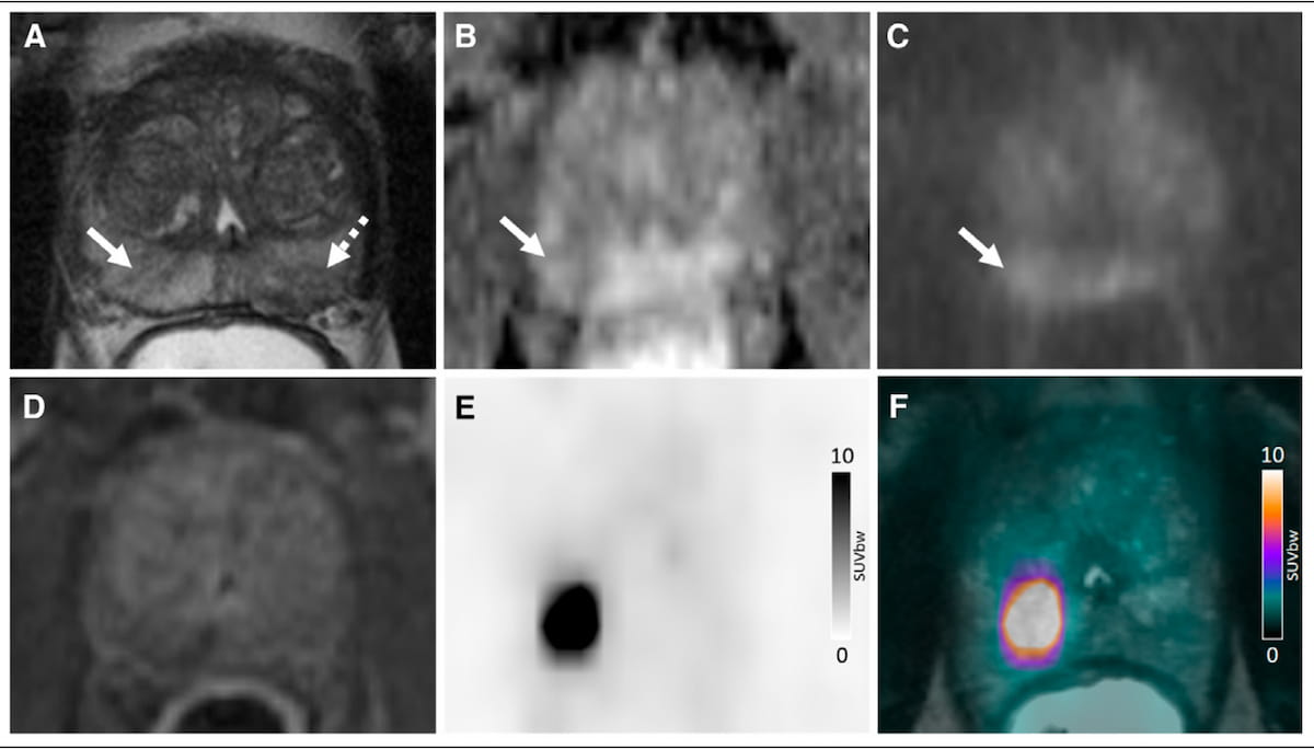 Study Says Use of 18F-flotufolastat PET/MRI May Reduce Prostate Biopsies by More Than 50 Percent