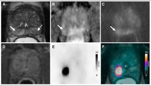 Study Says Use of 18F-flotufolastat PET/MRI May Reduce Prostate Biopsies by More Than 50 Percent
