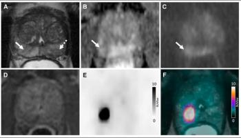 Study Says Use of 18F-flotufolastat PET/MRI May Reduce Prostate Biopsies by More Than 50 Percent