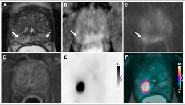 Study Says Use of 18F-flotufolastat PET/MRI May Reduce Prostate Biopsies by More Than 50 Percent