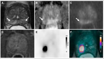 Study Says Use of 18F-flotufolastat PET/MRI May Reduce Prostate Biopsies by More Than 50 Percent