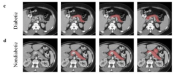 Predicting Diabetes on CT Scans: What New Research Reveals with Pancreatic Imaging Biomarkers