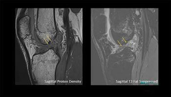 RSNA: Large Knee MRI Study Reveals Greater Incidence of ACL Tears in Men