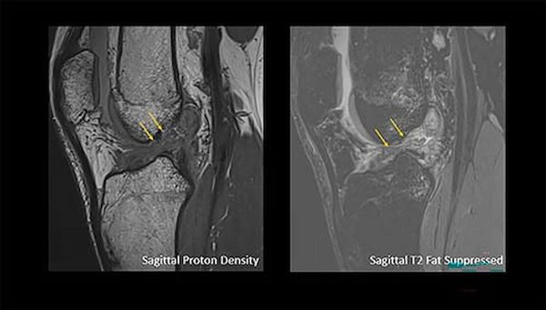 RSNA: Large Knee MRI Study Reveals Greater Incidence of ACL Tears in Men