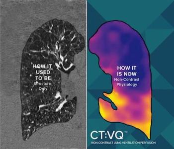 FDA Clears Non-Contrast CT-Based Ventilation Perfusion Imaging