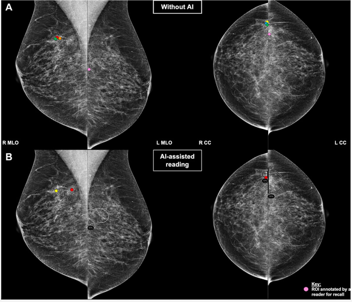 Mammogram Interpretation and AI Automation Bias: What New Research Reveals