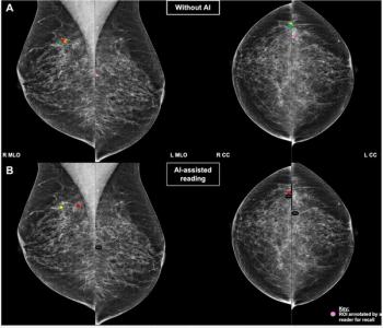 Mammogram Interpretation and AI Automation Bias: What New Research Reveals