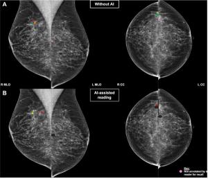 Mammogram Interpretation and AI Automation Bias: What New Research Reveals