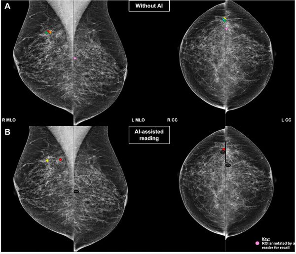 Mammogram Interpretation and AI Automation Bias: What New Research Reveals