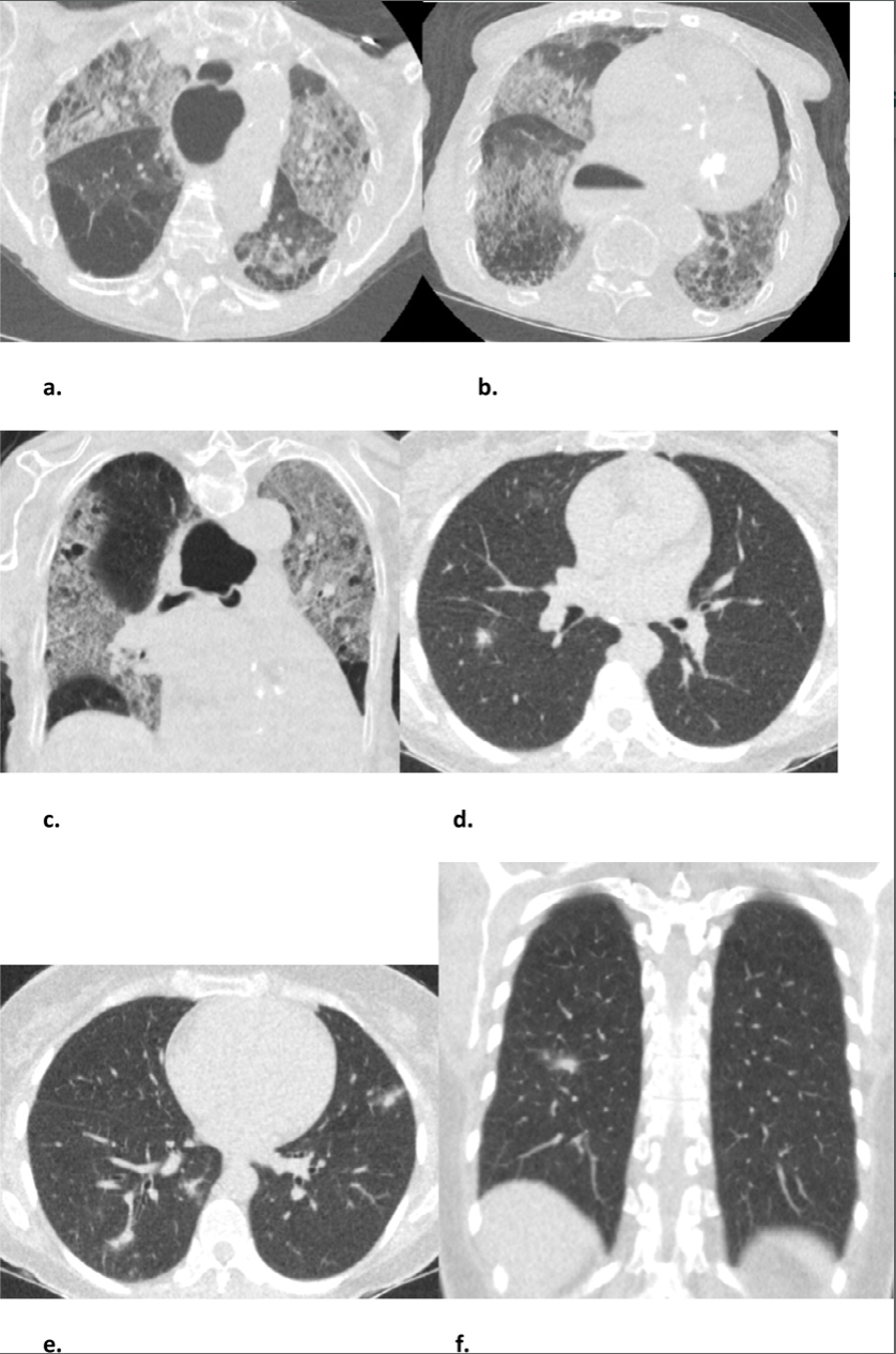 Pairing Chest Ct And Co Rads Gives Rapid Test Result For Some Covid 19 Patients