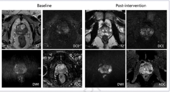 ACR Collaborative Model Achieves 20 Percent Improvement in PI-QUAL Scores for Prostate MRI
