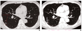 What is the Best Use of AI in CT Lung Cancer Screening?