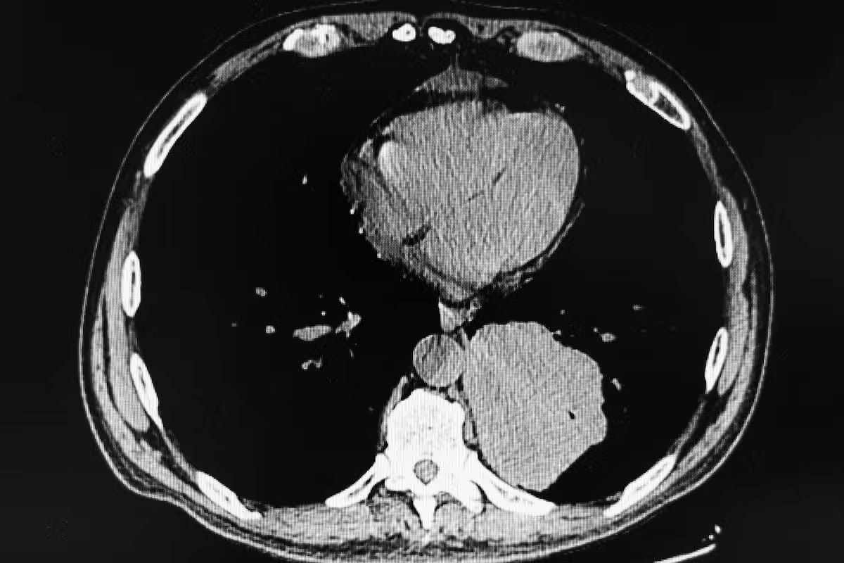 HOPPR Unveils New AI Foundation Model for Chest CT