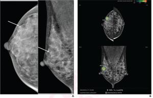 Mammography Study Assesses Ability of AI to Predict DCIS Recurrence After Breast Surgery